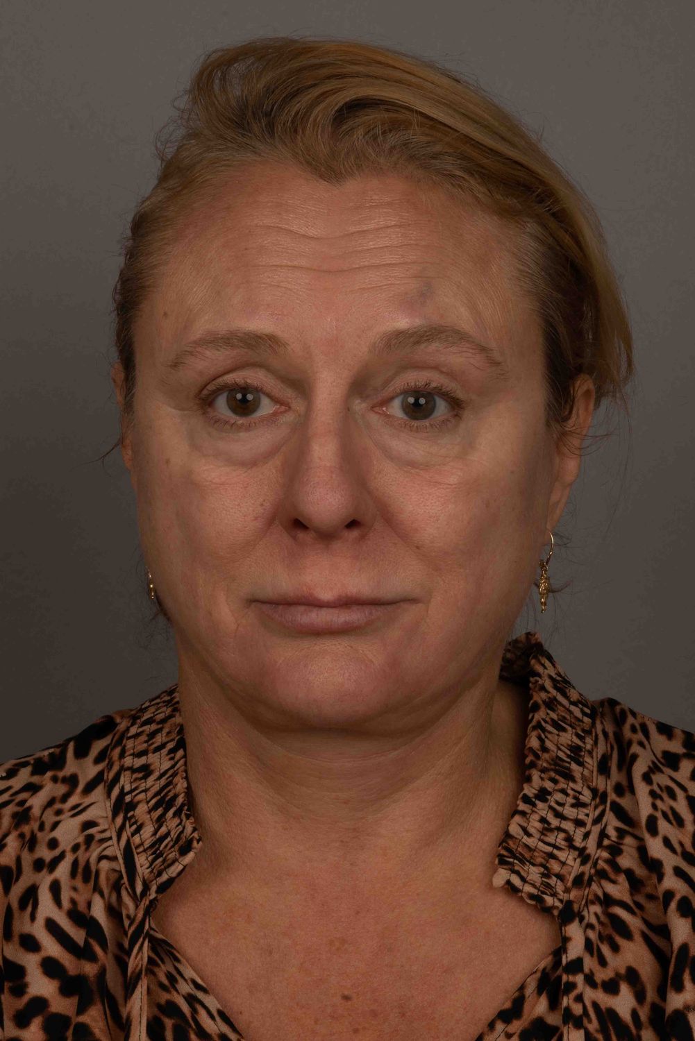 Facelift Before & After