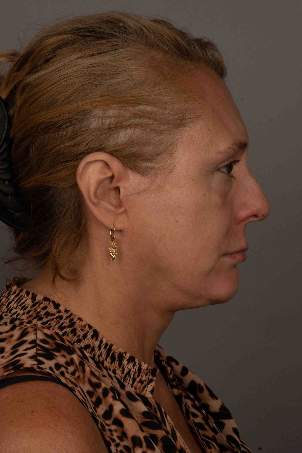 Facelift Before & After