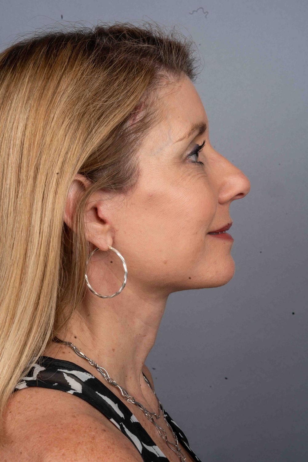 Facelift Before & After