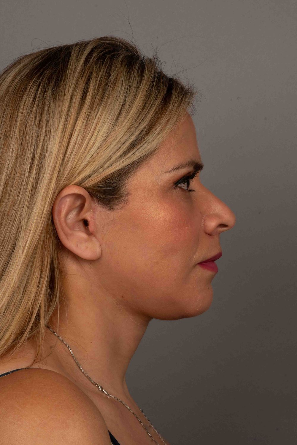 Facelift Before & After