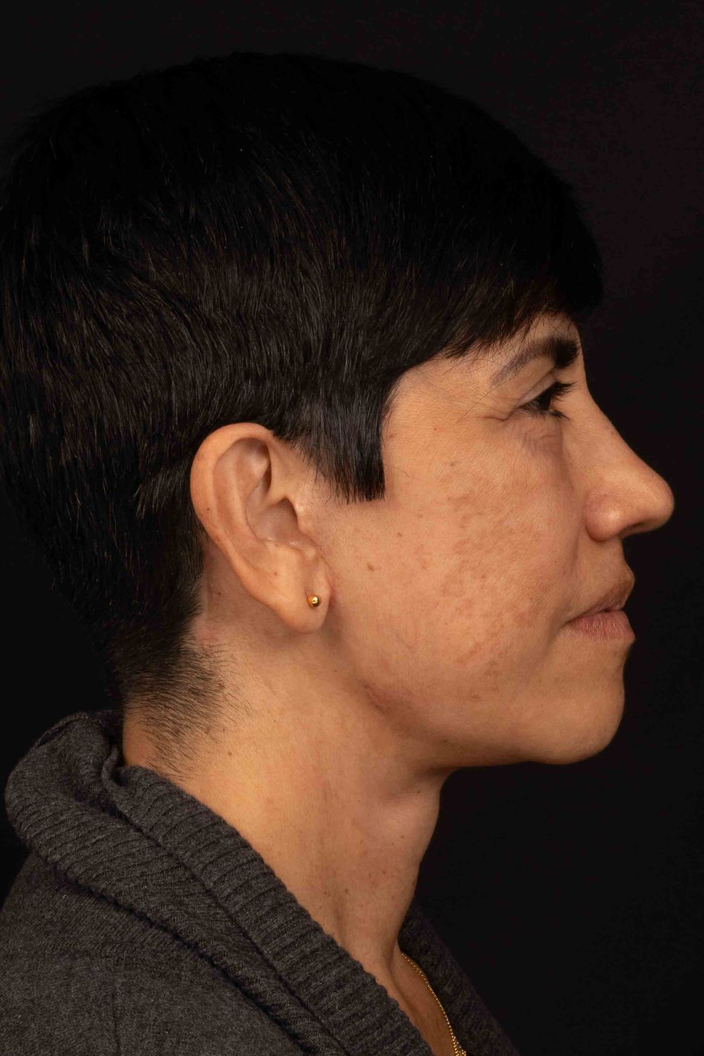 Facelift Before & After