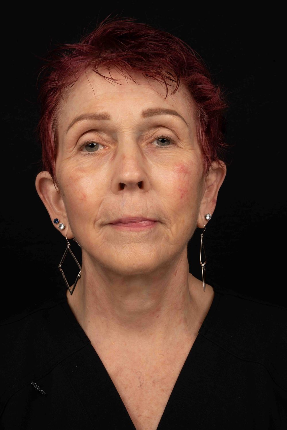 Facelift Before & After