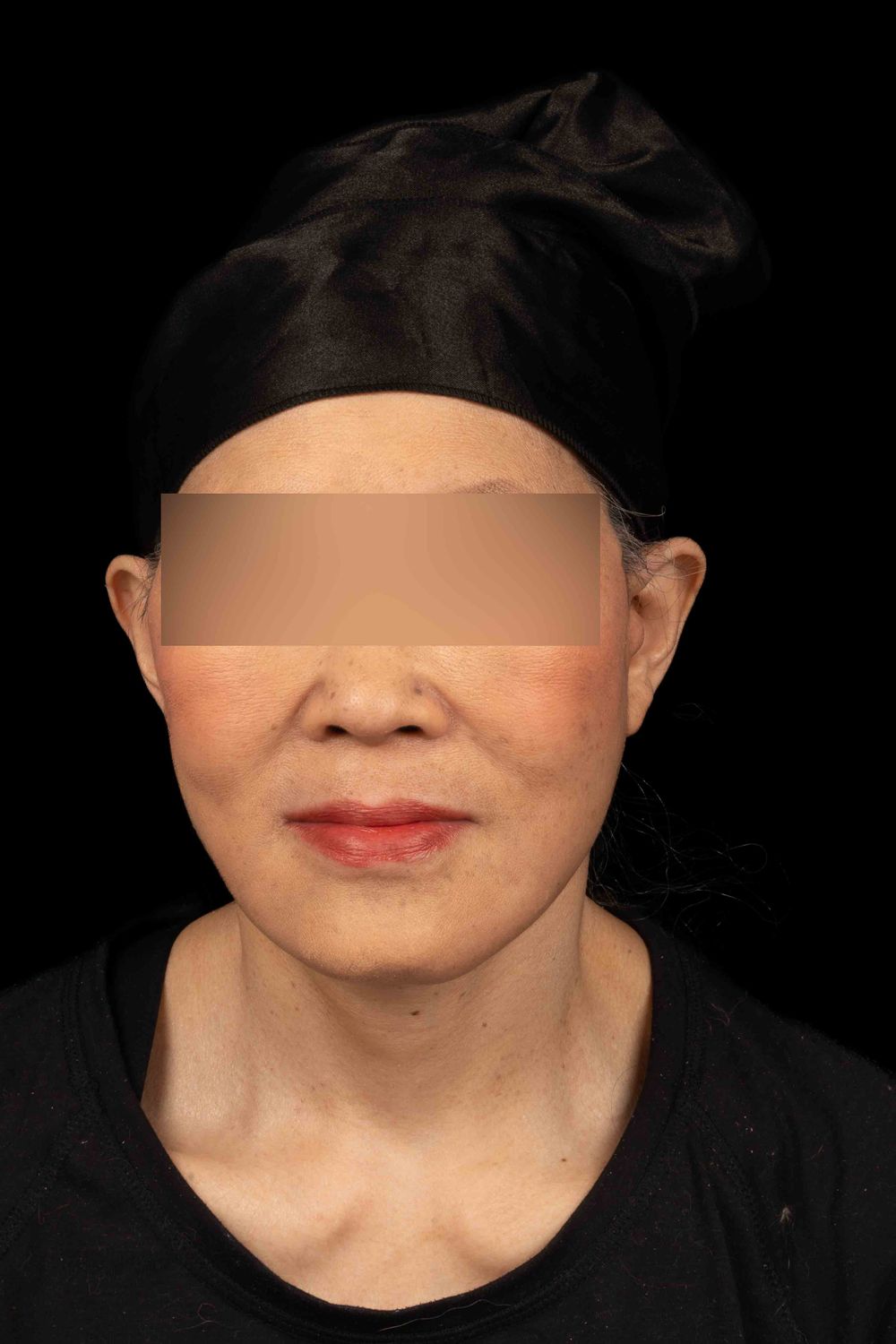 Facelift Before & After