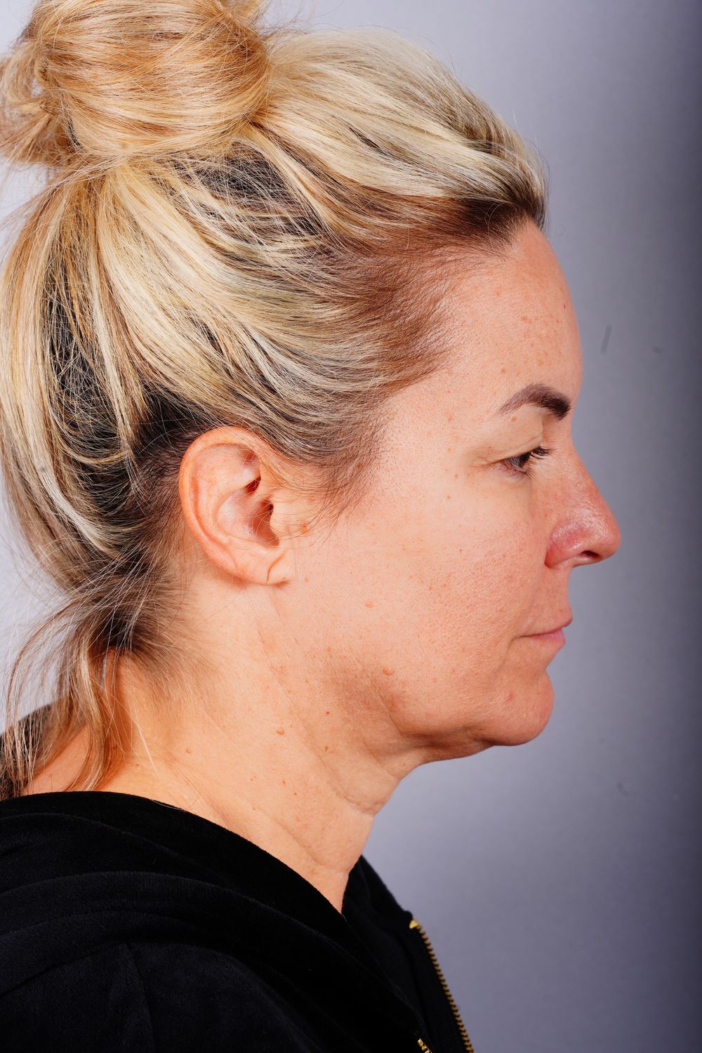 Facelift Before & After