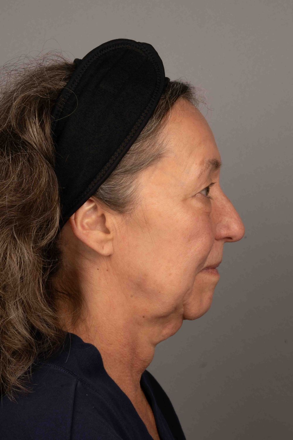 Facelift Before & After