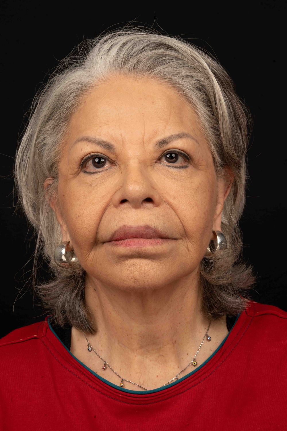 Facelift Before & After