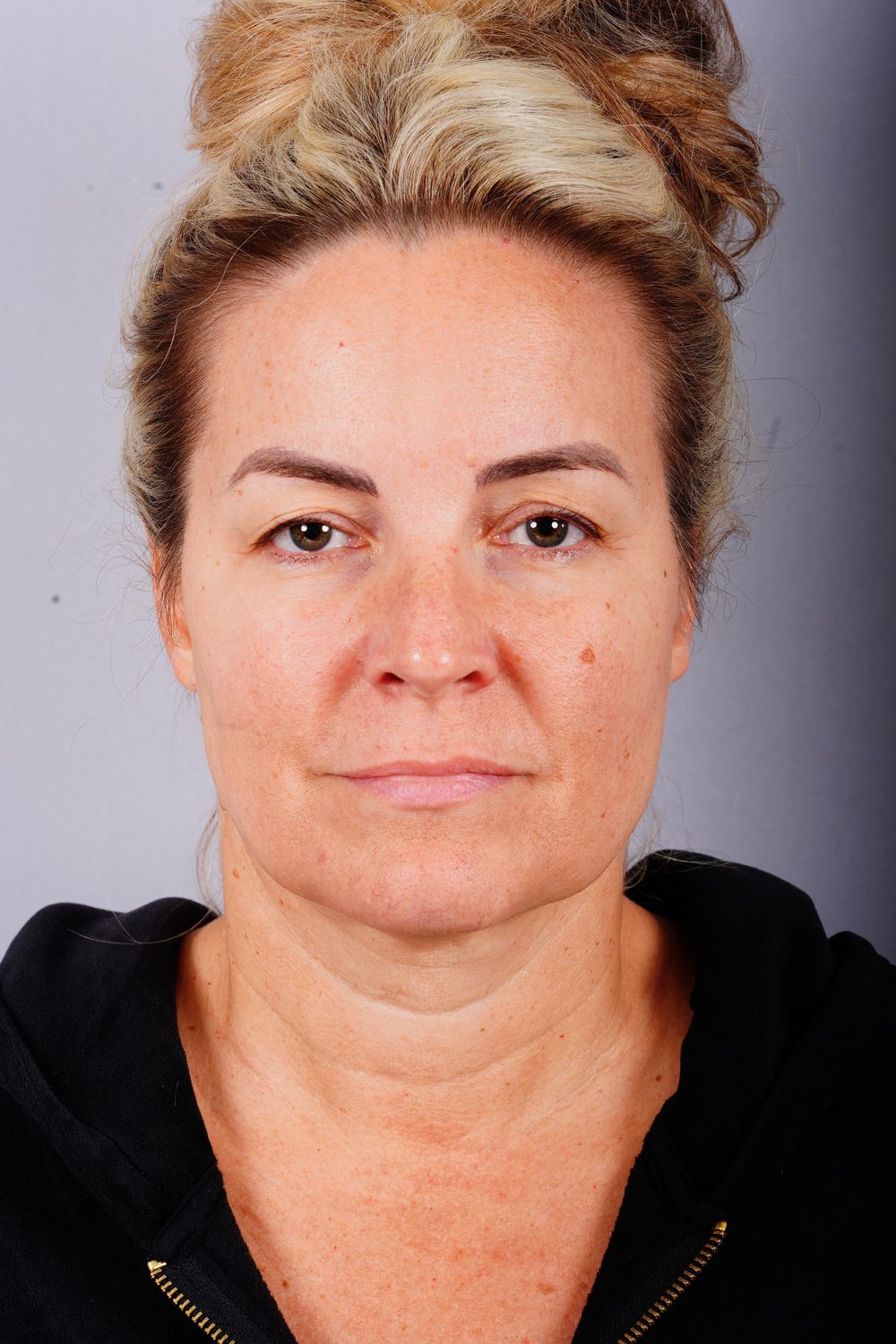 Facelift Before & After