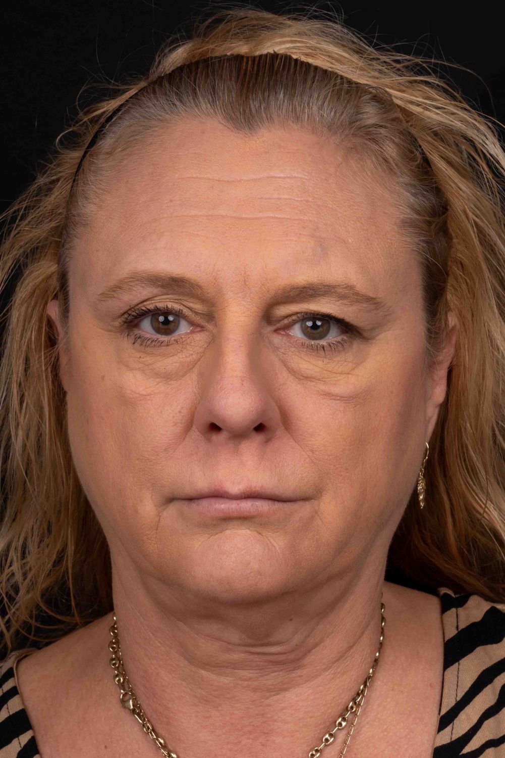 Facelift Before & After