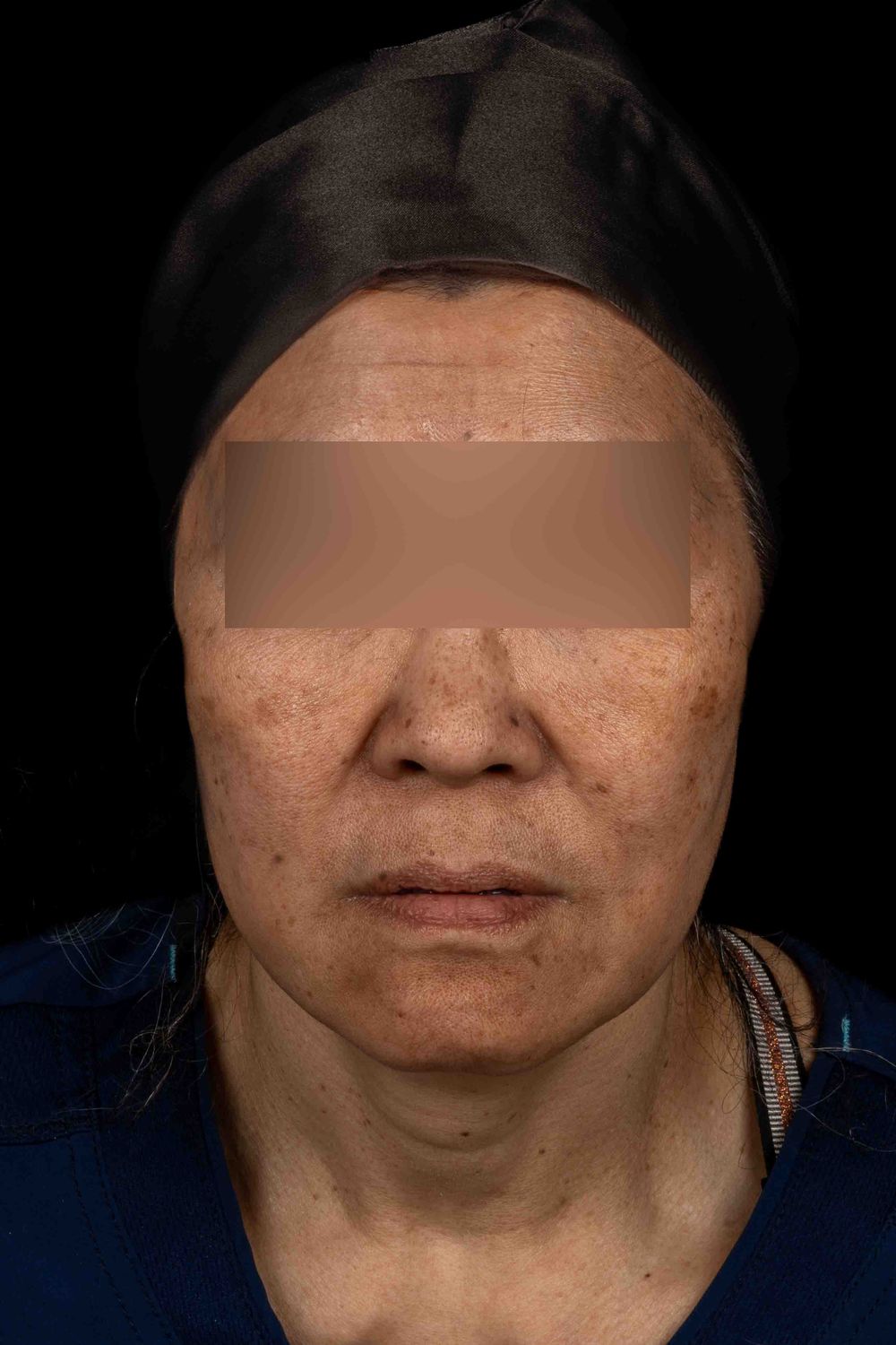 Facelift Before & After