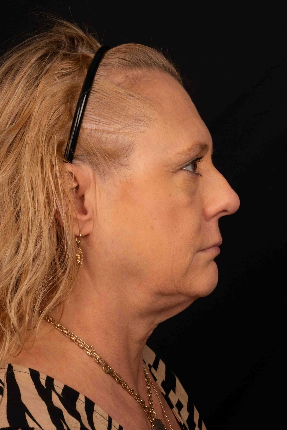 Facelift Before & After