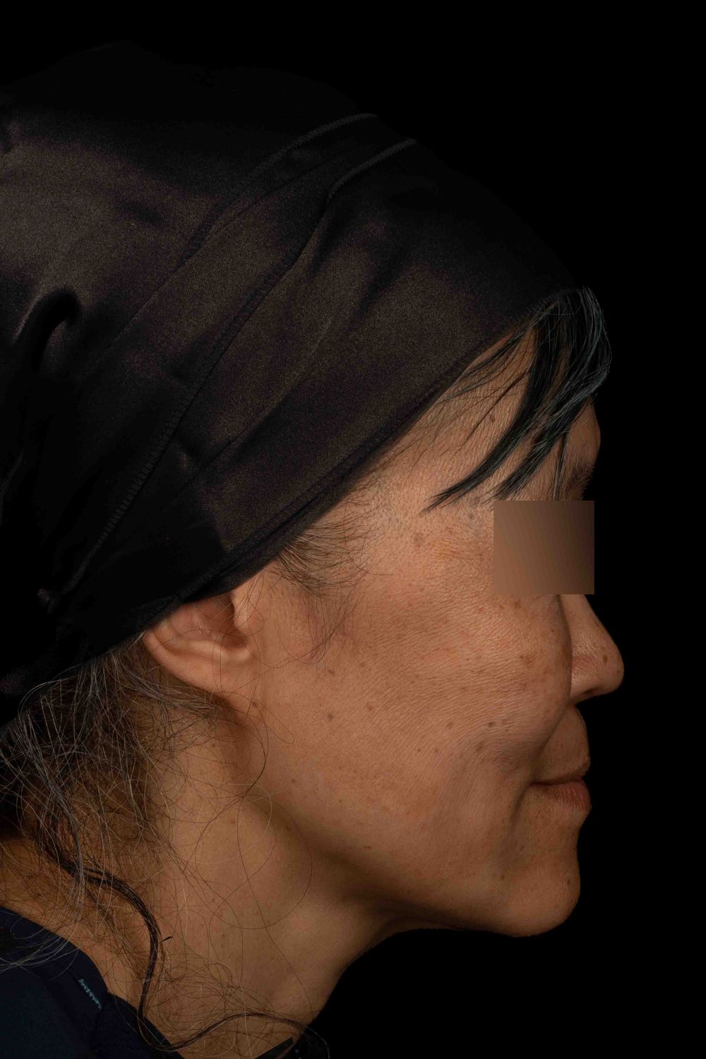 Facelift Before & After