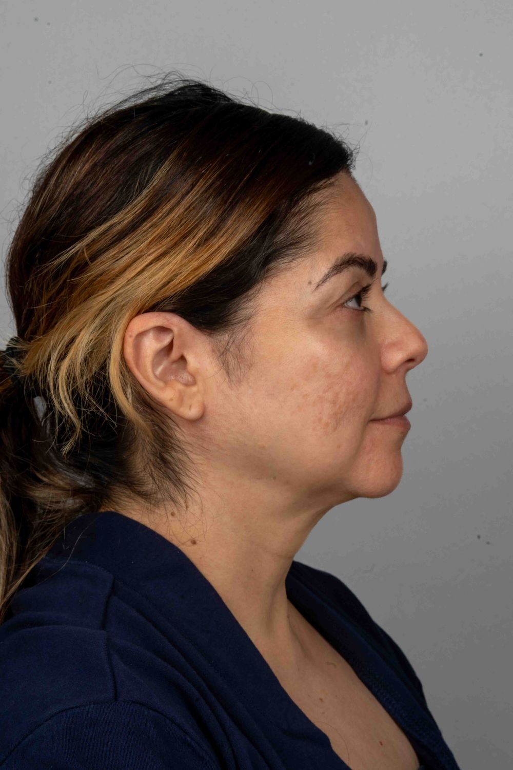 Facelift Before & After