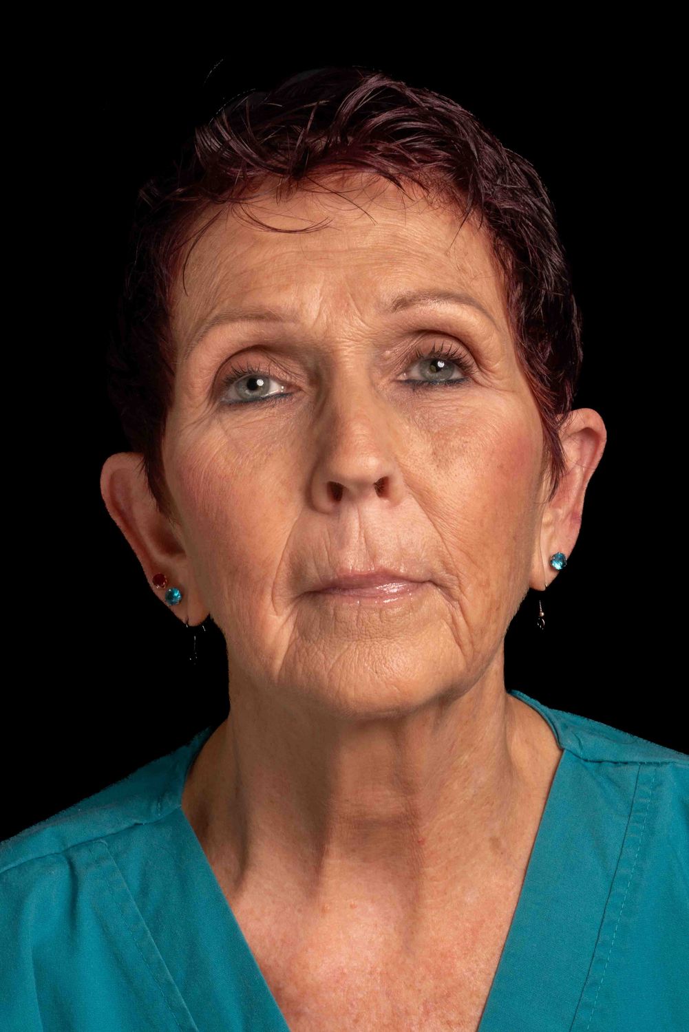 Facelift Before & After