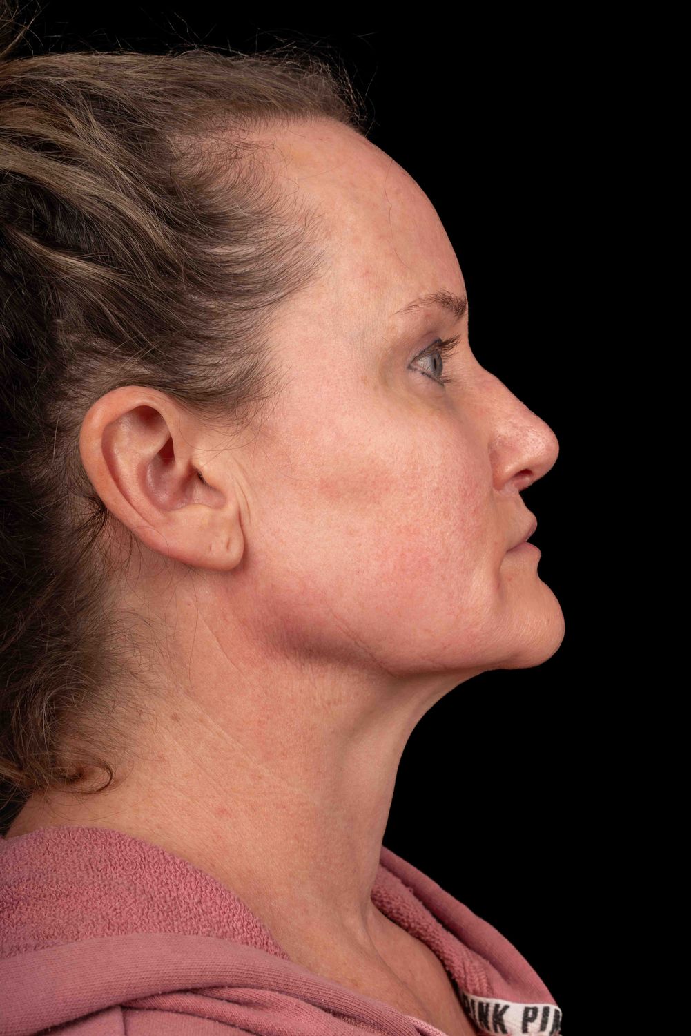 Facelift Before & After