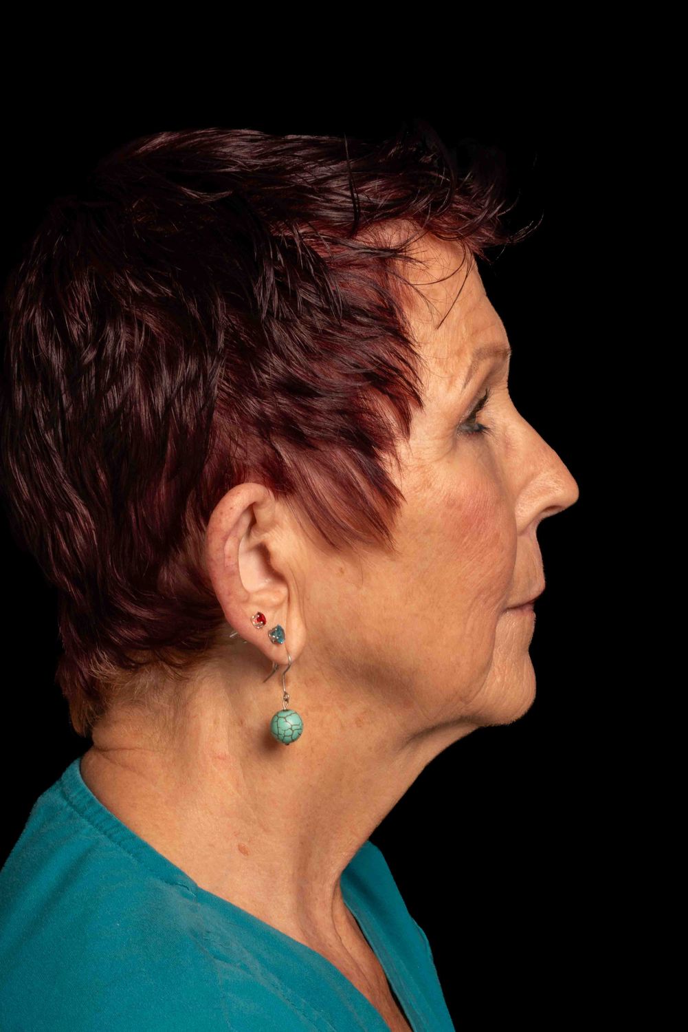 Facelift Before & After