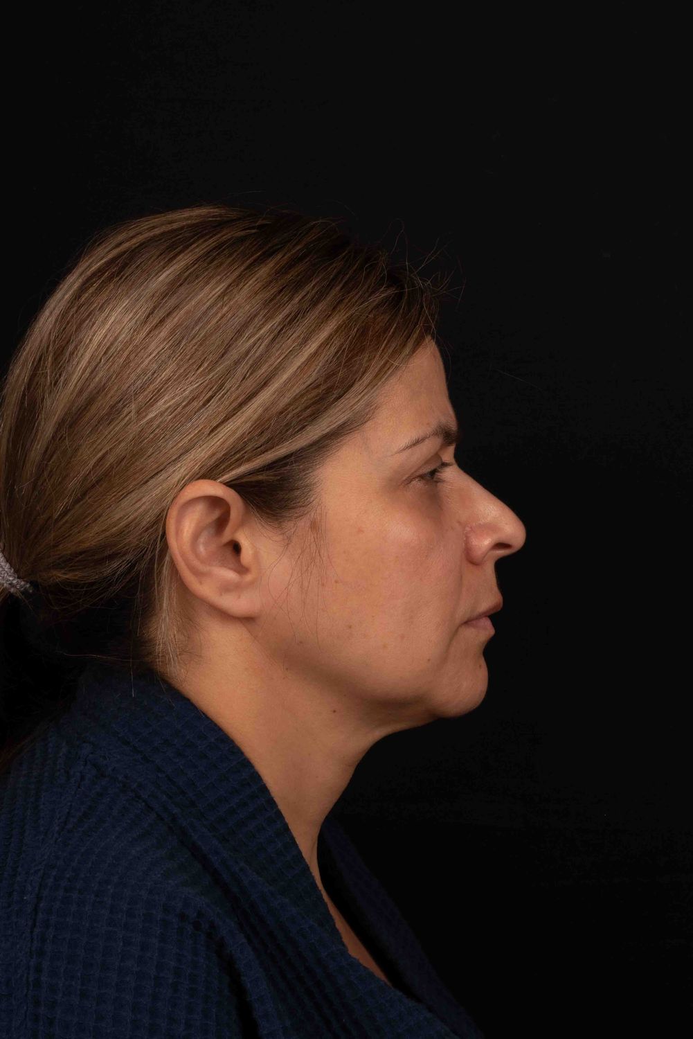 Facelift Before & After