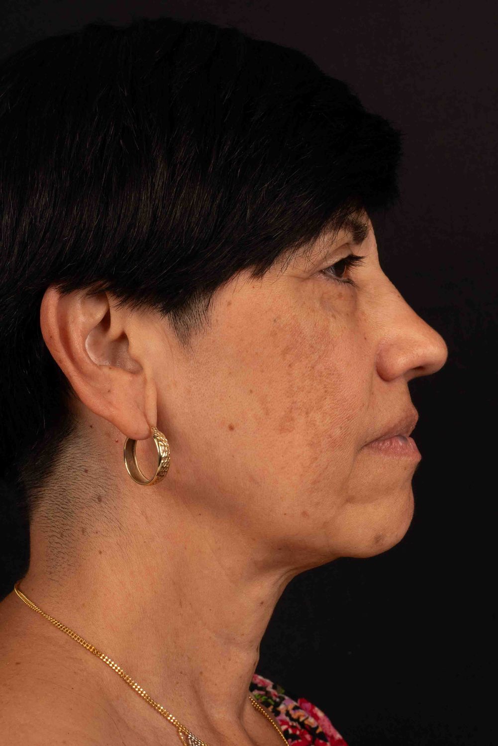 Facelift Before & After