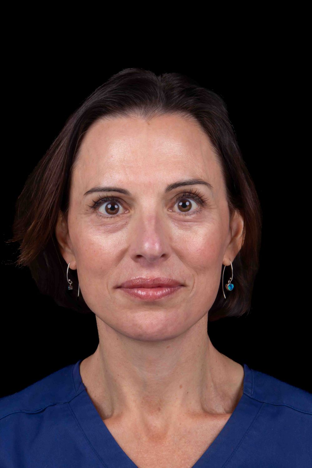 Facelift Before & After