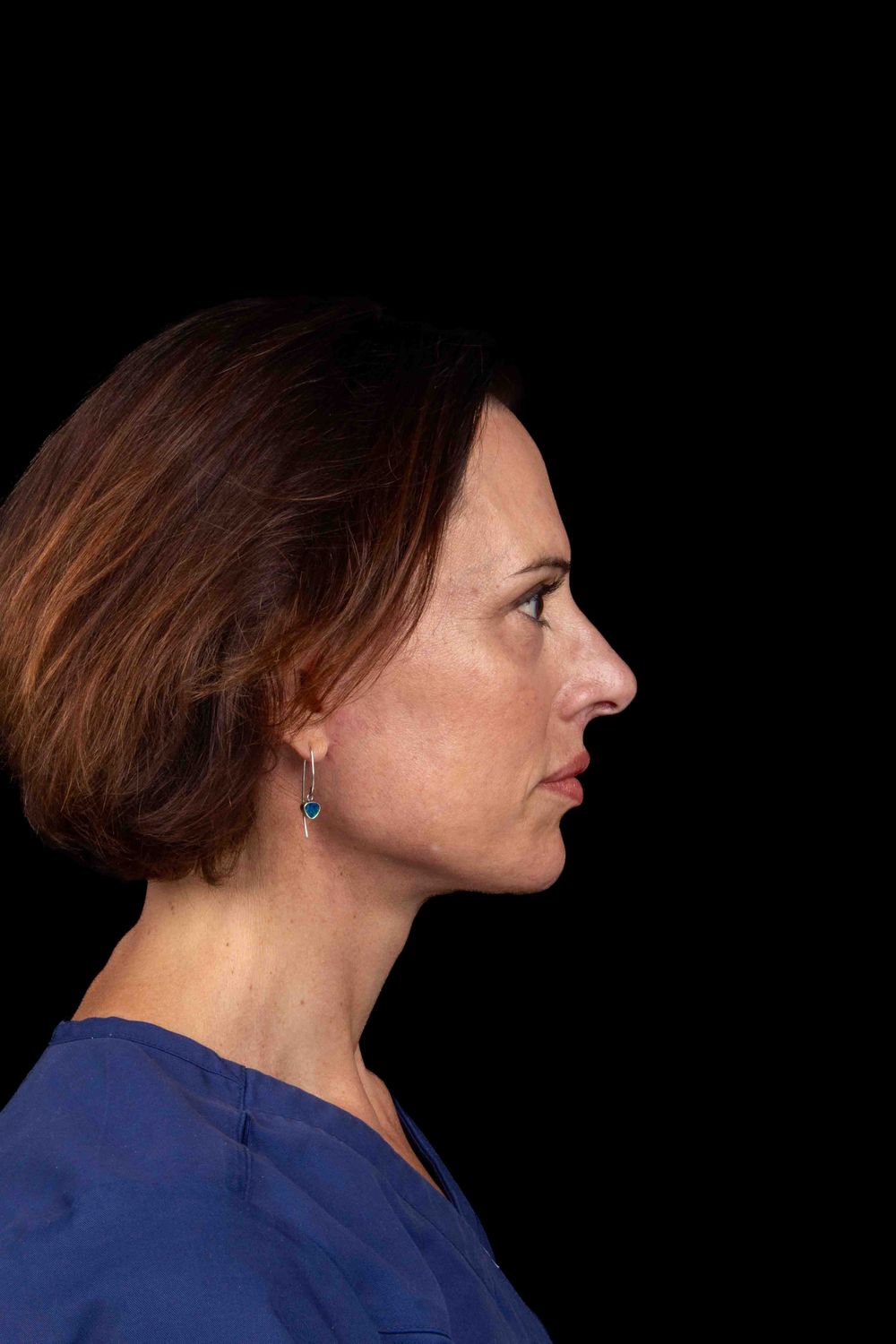 Facelift Before & After