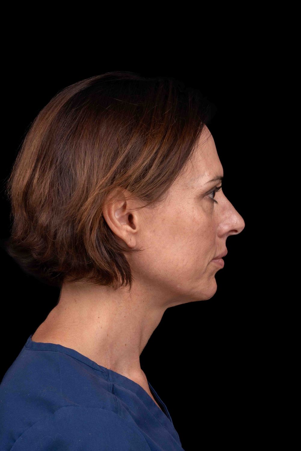 Facelift Before & After