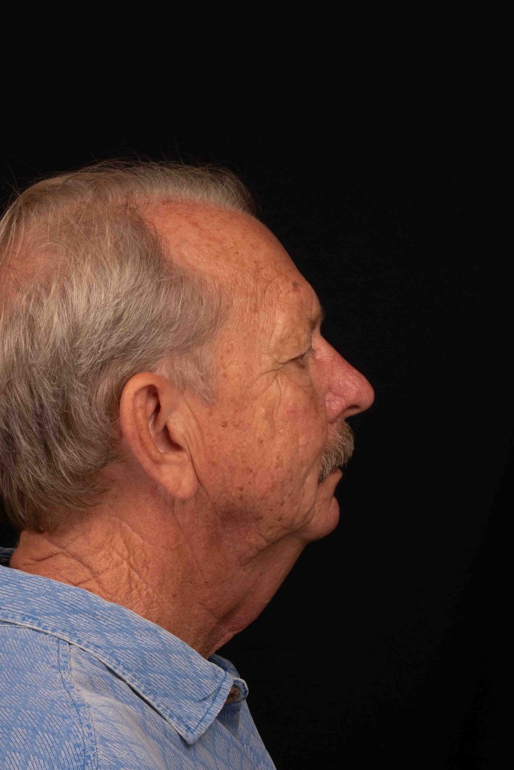 Facelift Before & After