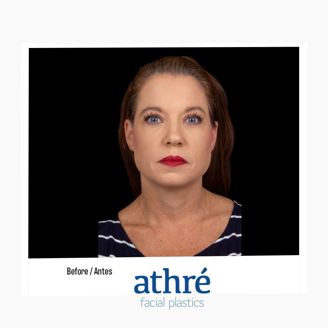 Lip Augmentation Before & After