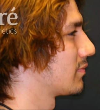 Chin Augmentation Before & After