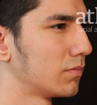 Chin Augmentation Before & After