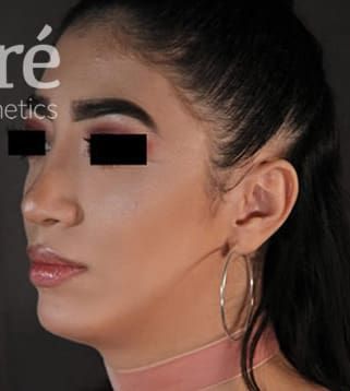 Chin Augmentation Before & After