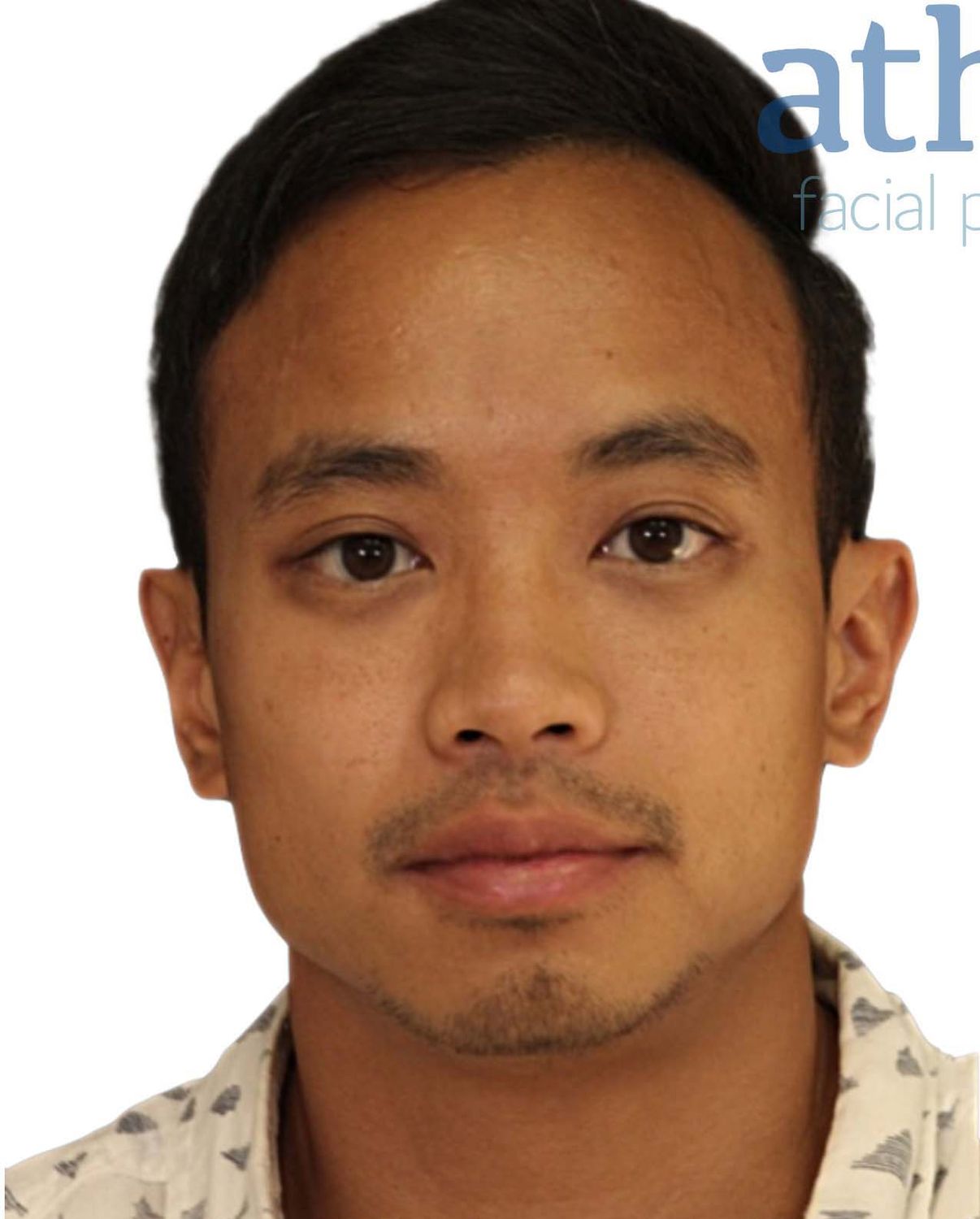 Chin Augmentation Before & After