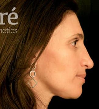 Chin Augmentation Before & After