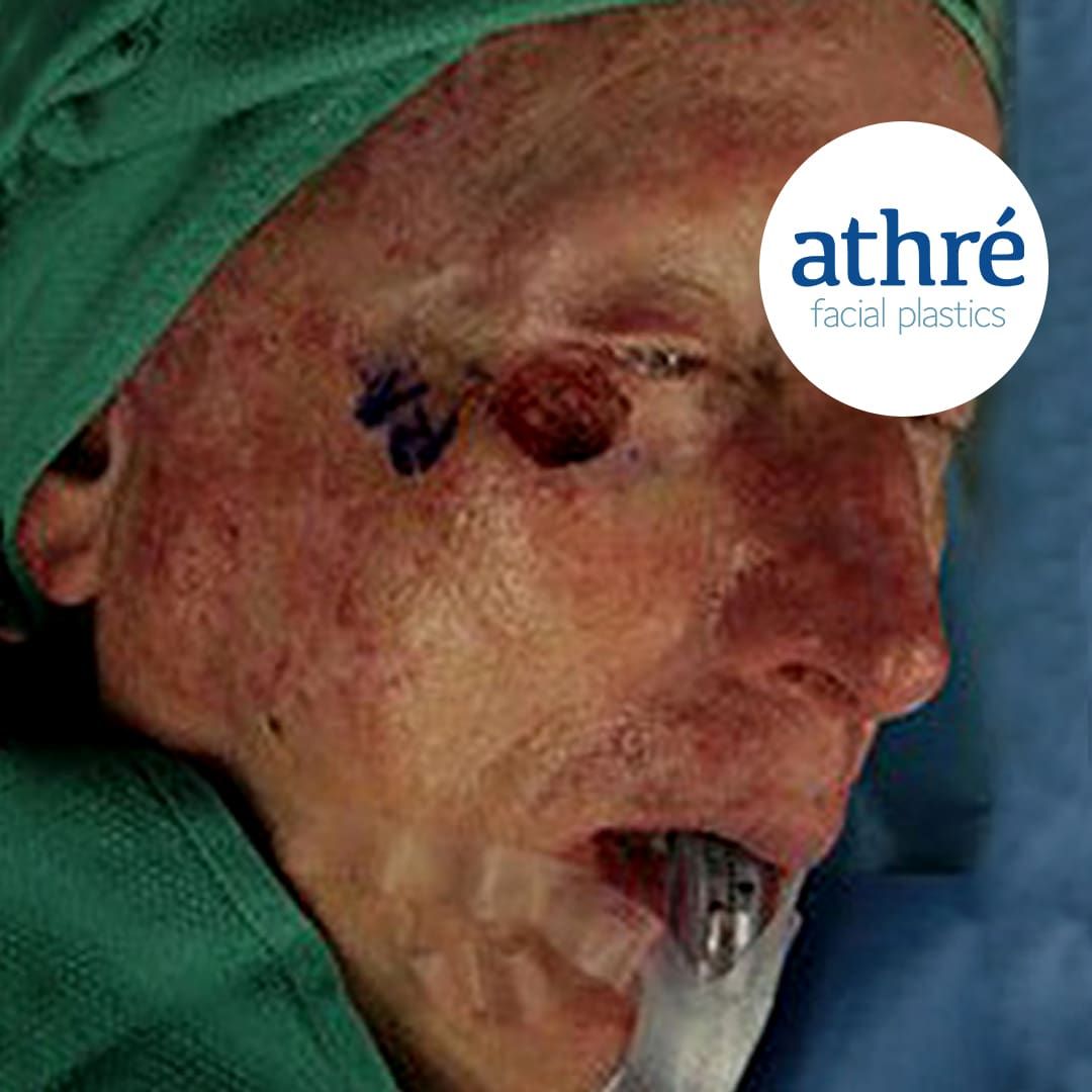 Eyelid Surgery Before & After