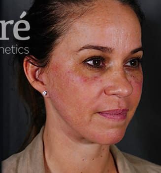 Eyelid Surgery Before & After