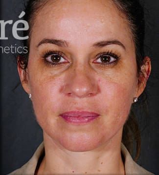 Eyelid Surgery Before & After