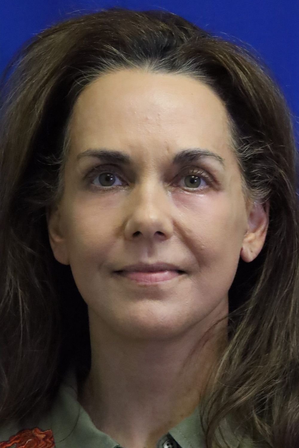 Eyelid Surgery Before & After