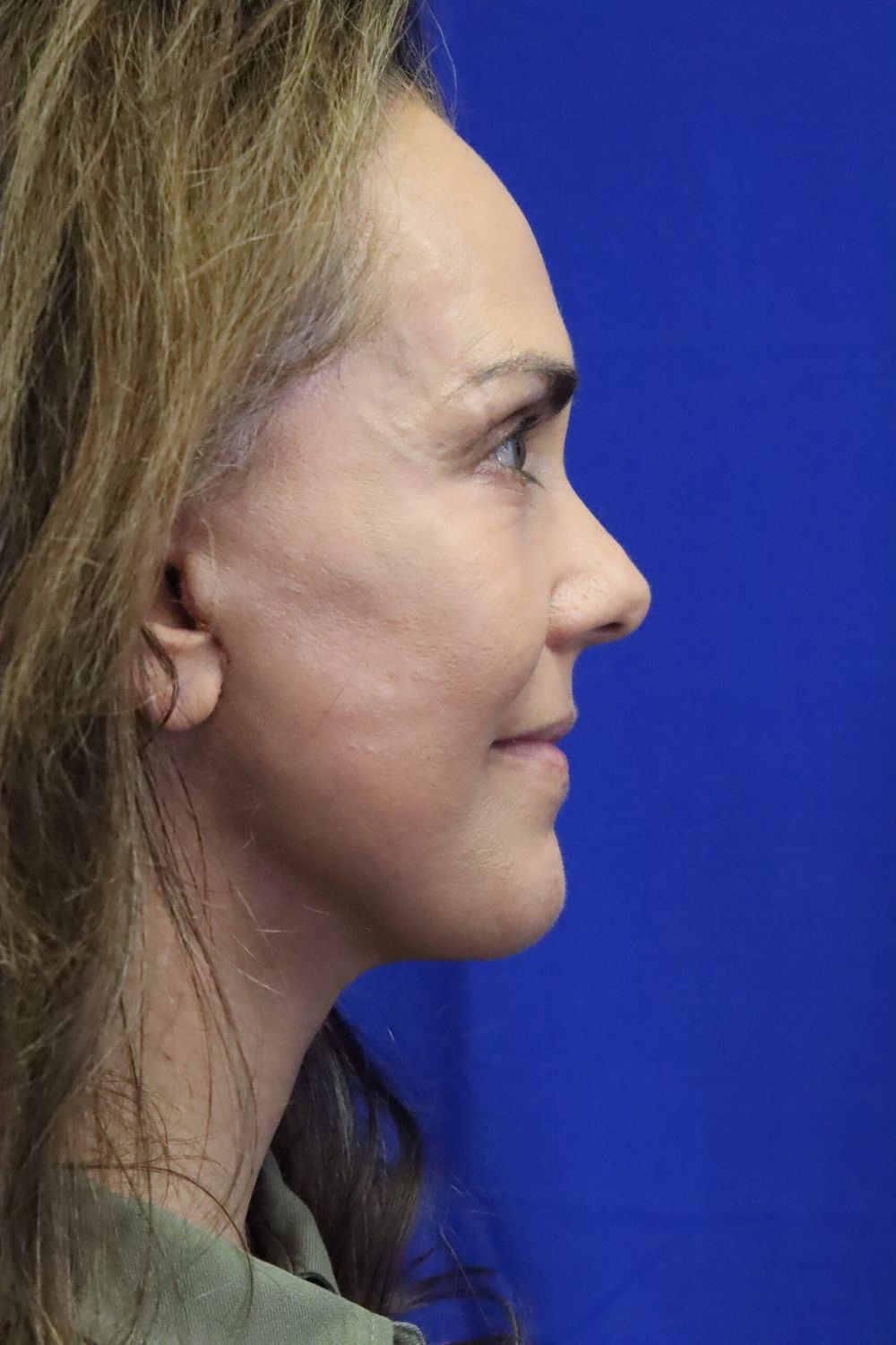 Eyelid Surgery Before & After