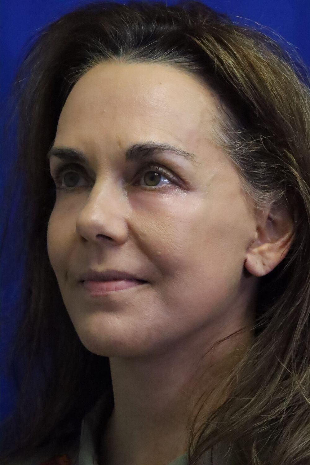 Eyelid Surgery Before & After