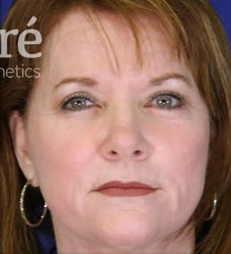 Eyelid Surgery Before & After