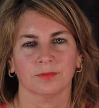 Eyelid Surgery Before & After