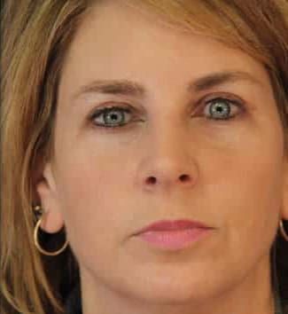 Eyelid Surgery Before & After