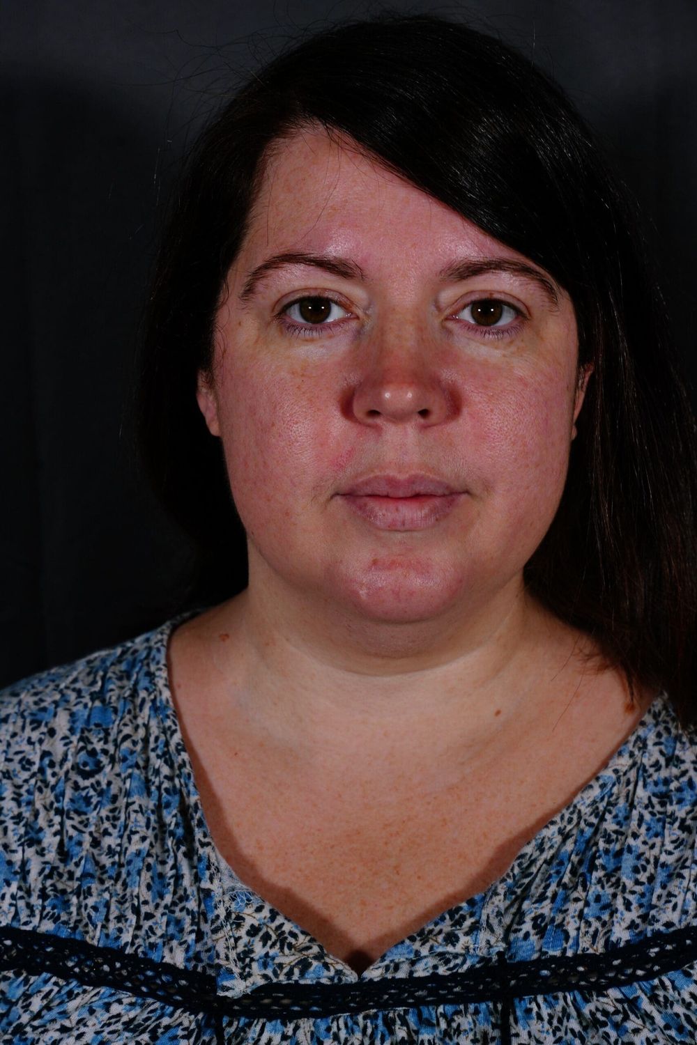 Eyelid Surgery Before & After