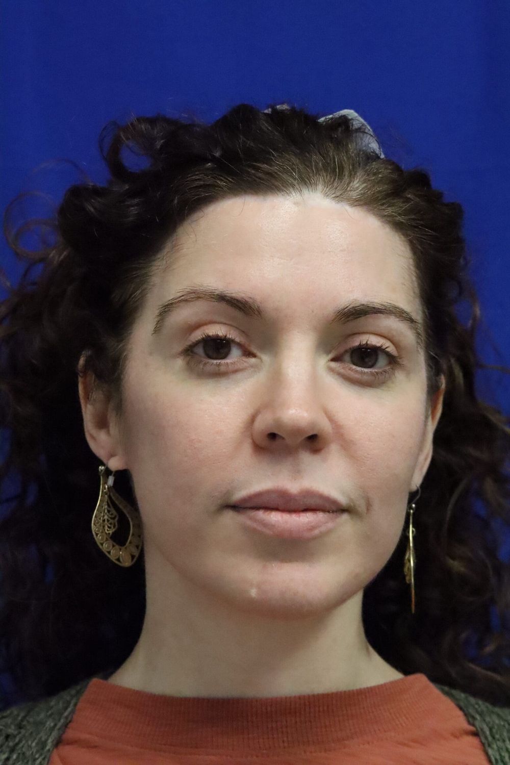 Eyelid Surgery Before & After