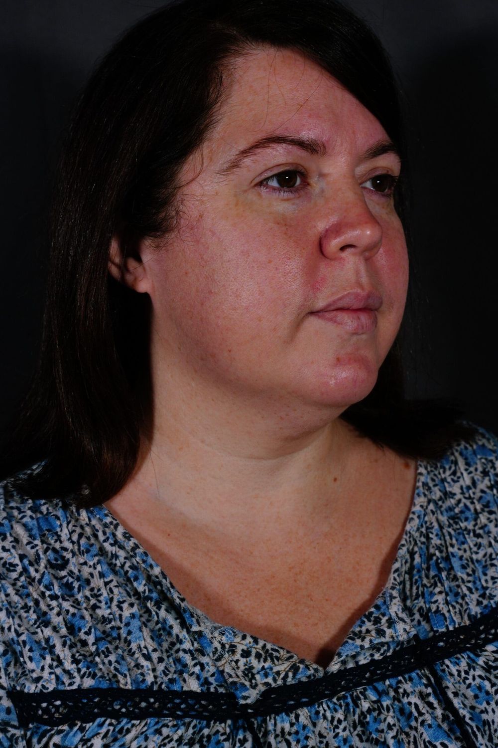 Eyelid Surgery Before & After