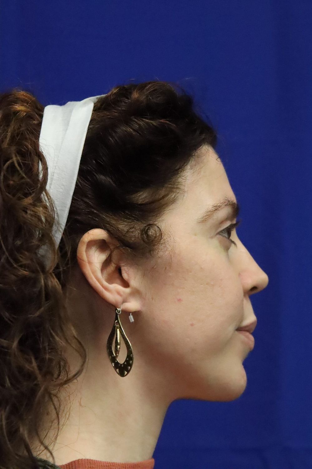 Eyelid Surgery Before & After