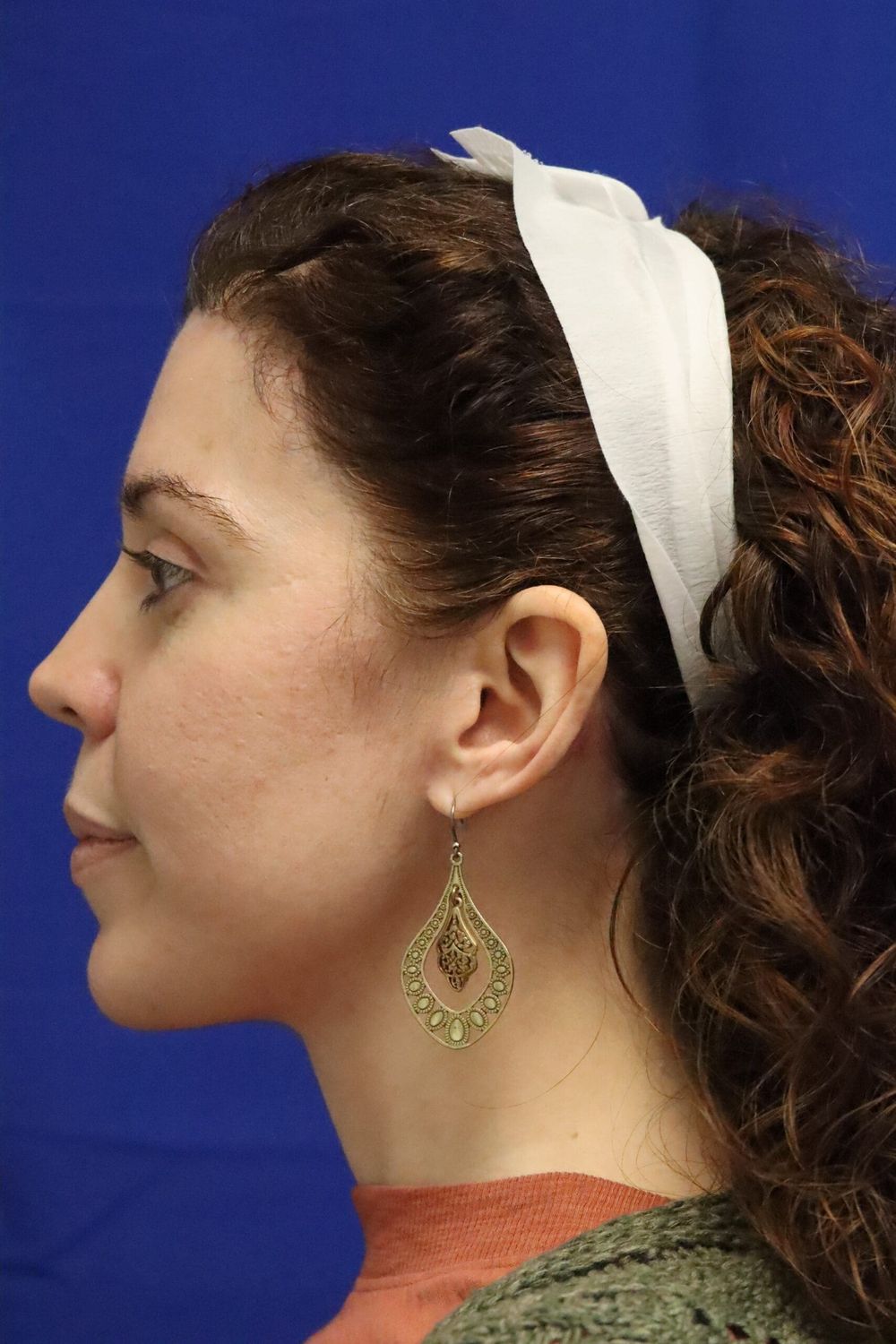 Eyelid Surgery Before & After