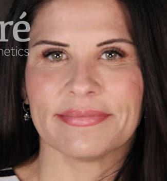 Eyelid Surgery Before & After