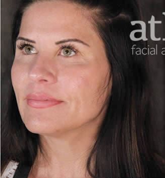 Eyelid Surgery Before & After