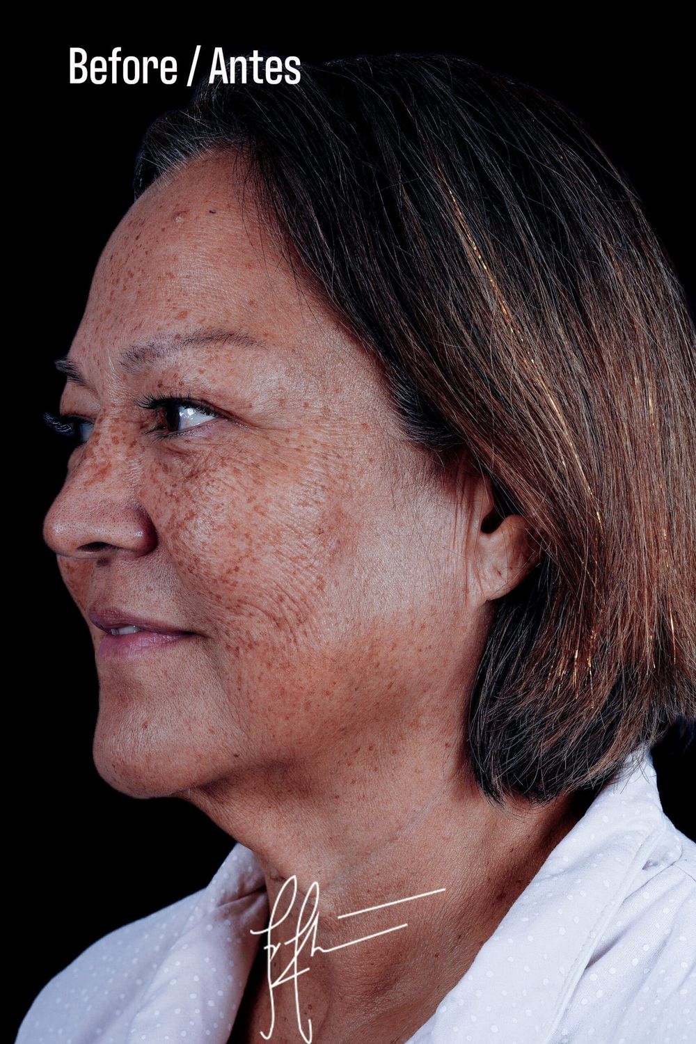 Eyelid Surgery Before & After