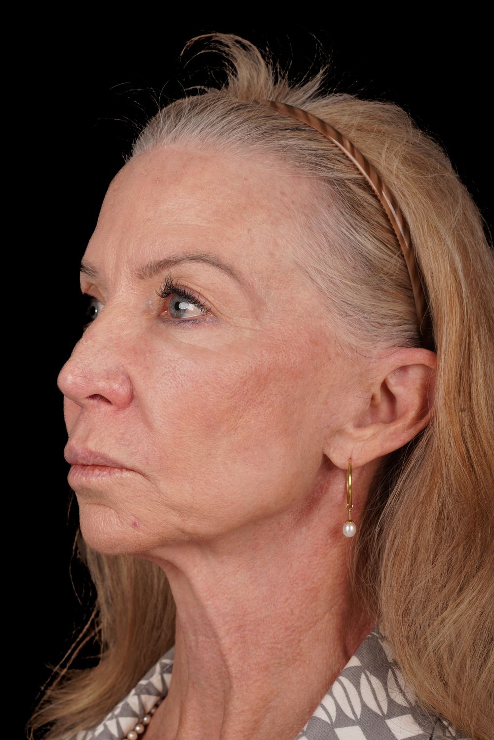 Eyelid Surgery Before & After