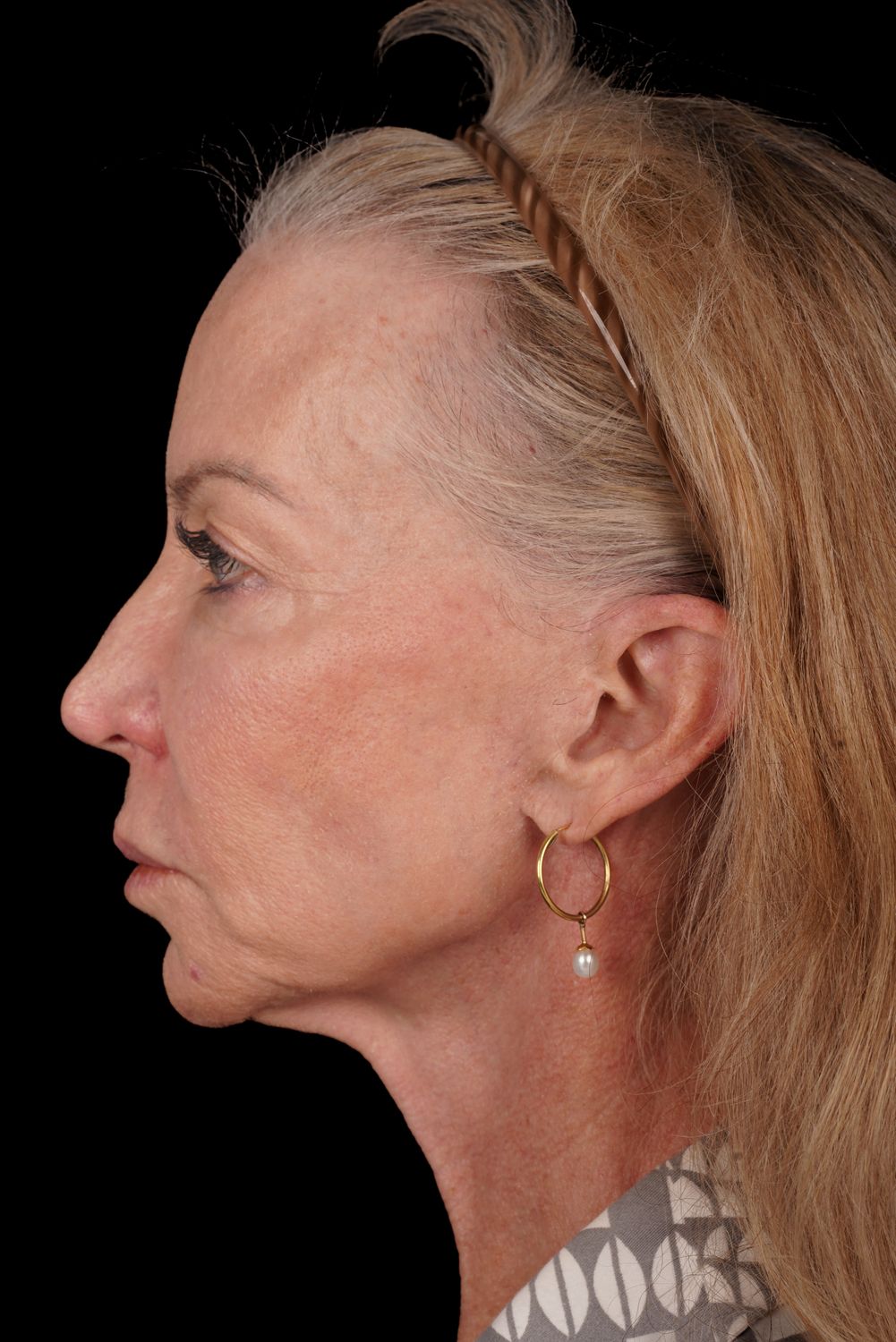 Eyelid Surgery Before & After